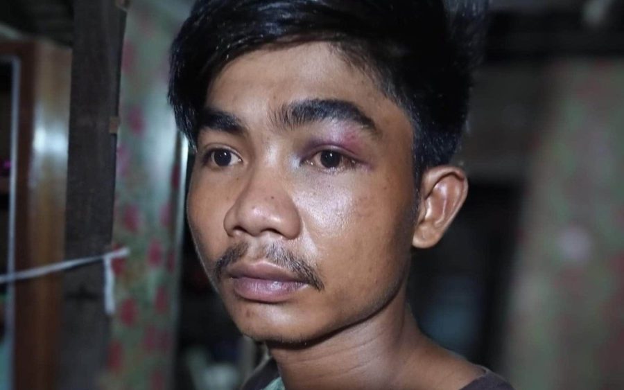 Thai Sameat says he was beaten by Prey Veng police officers on July 20, 2020, with a photo of his black eye from the incident supplied by Sameat.