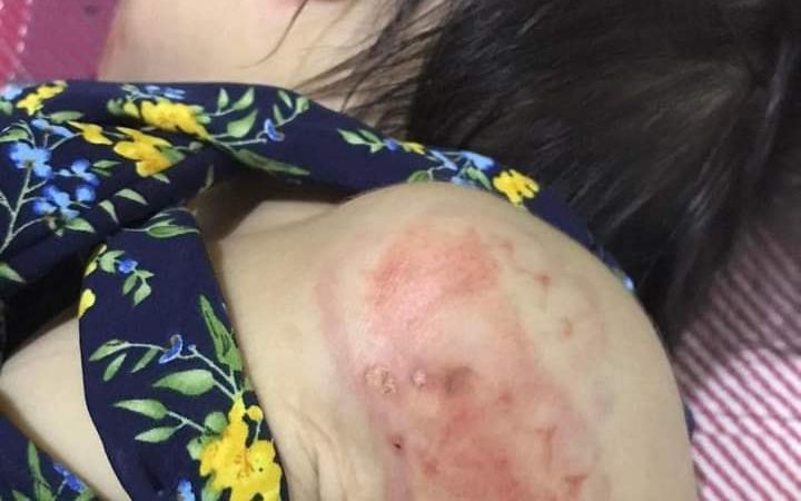 A photo of the marks on a 13-month-old child allegedly bitten by Siem Reap police officer Rith Virak, posted to Facebook by the mother on March 21, 2022. ("Great Moms Modern Women" Facebook group) 