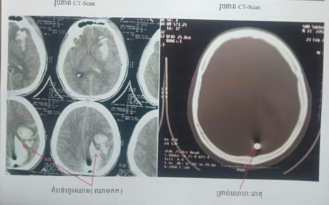 A scan that the victim’s family said shows a bullet inside the victim’s head. (Supplied)