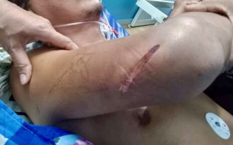 A photo supplied by Hay Bunna's family showing him in a hospital bed with a scar on his right arm.